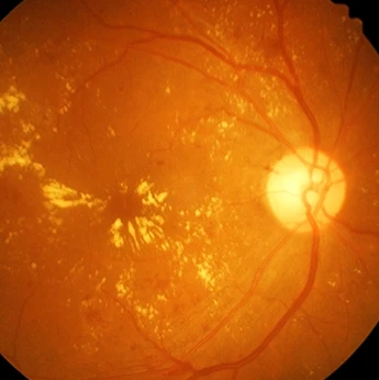 Diabetic Eye Care image